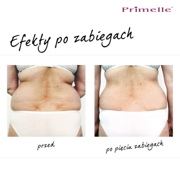 Endermologia Primelle - obrazek 11