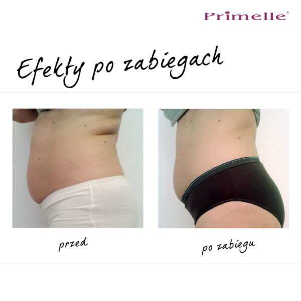 Endermologia Primelle - obrazek 13