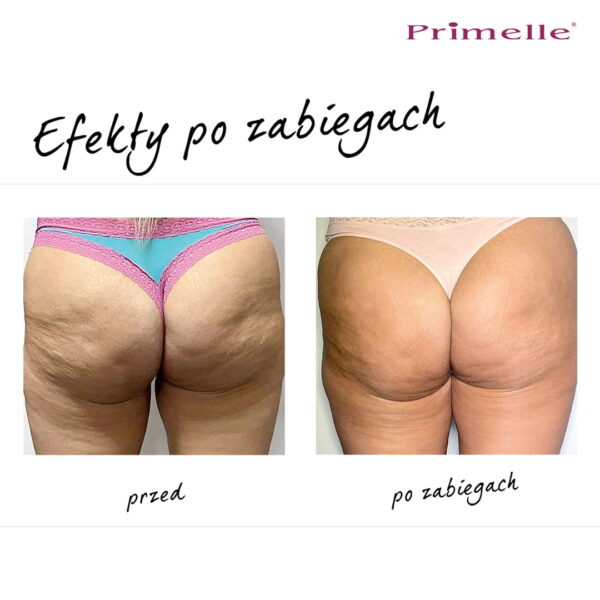 Endermologia Primelle - obrazek 9