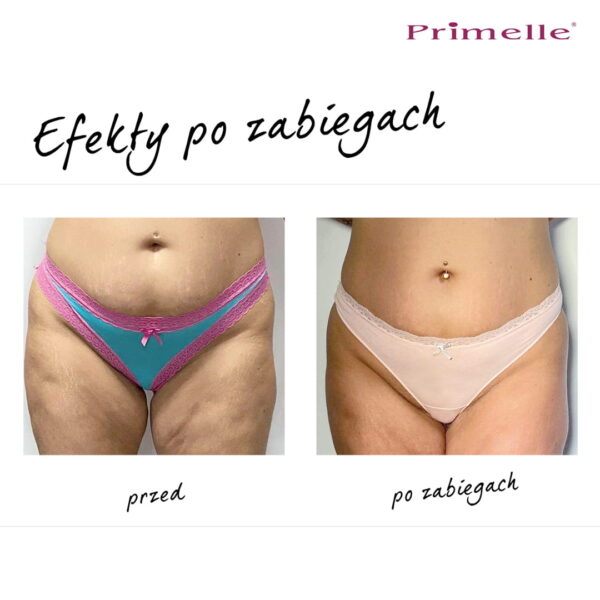 Endermologia Primelle - obrazek 7