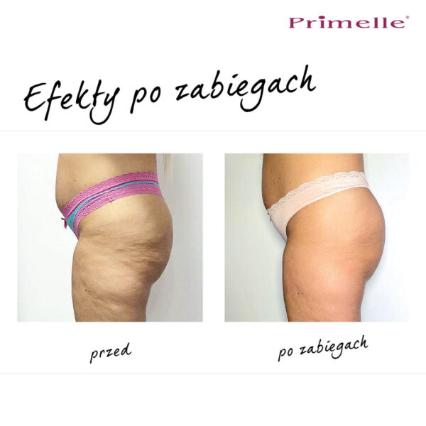 Endermologia Primelle - obrazek 21