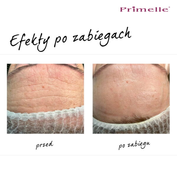 Endermologia Primelle - obrazek 6