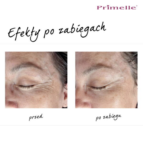 Endermologia Primelle - obrazek 3
